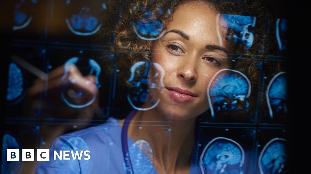 New Alzheimer's drug slows disease by a third